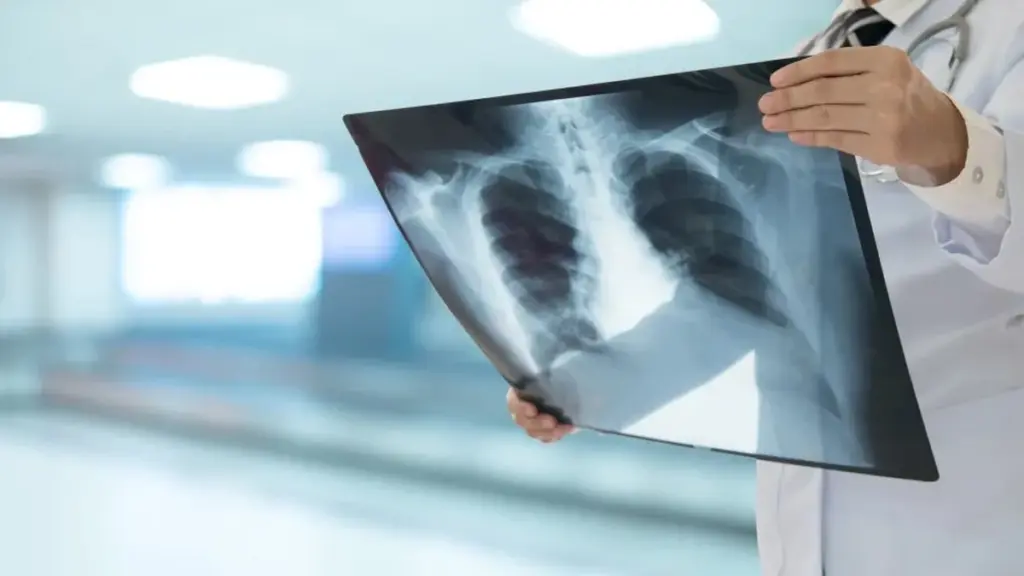 Cómo la gripe debilita tus defensas pulmonares y abre la puerta a neumonías mortales