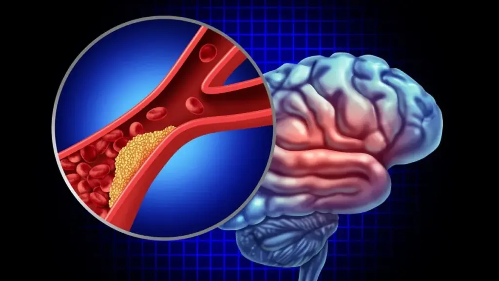 Ministro sofre 'mini-AVC': Aprenda a reconhecer os sintomas silenciosos do AIT