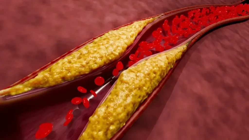 5 señales de que tus arterias podrían estar bloqueadas (y qué hacer)
