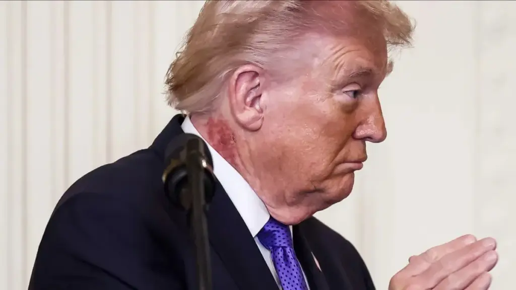 La misteriosa mancha en el cuello de Trump: médicos revelan posibles causas y su gravedad