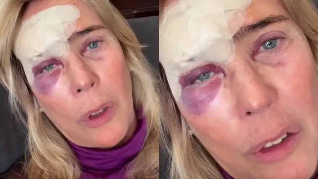 Por que esta apresentadora usa um pedaço de batata nos olhos após cirurgia de pele